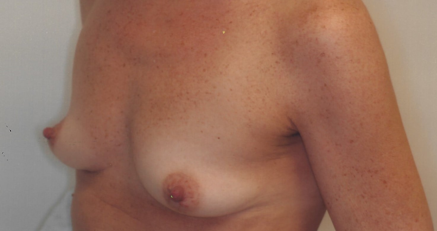 Before — breast augmentation, case 1, Forest Hills Plastic Surgery