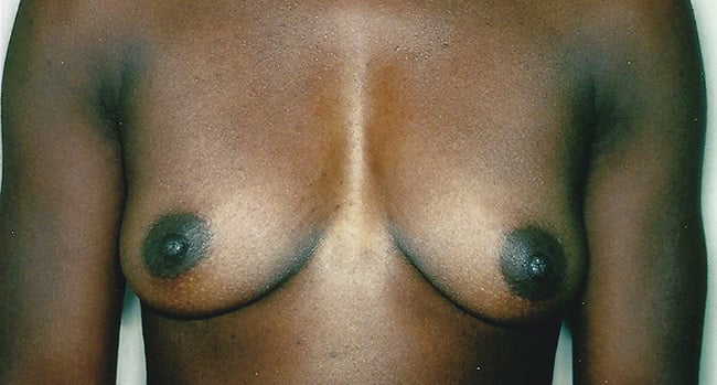 Before — breast augmentation, case 2, Forest Hills Plastic Surgery