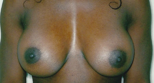 After — breast augmentation, case 2, Forest Hills Plastic Surgery