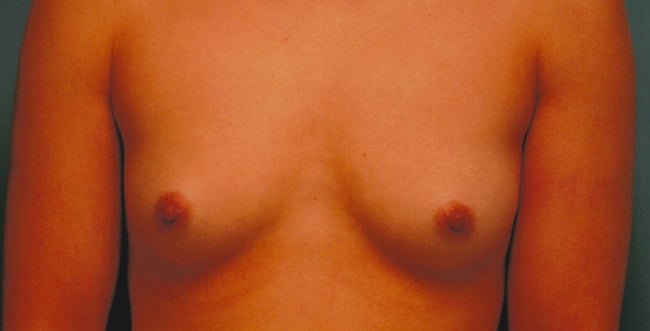 Before — breast augmentation, case 3, Forest Hills Plastic Surgery