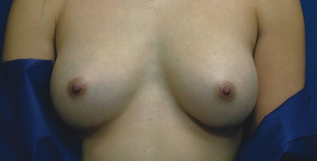 After — breast augmentation, case 3, Forest Hills Plastic Surgery