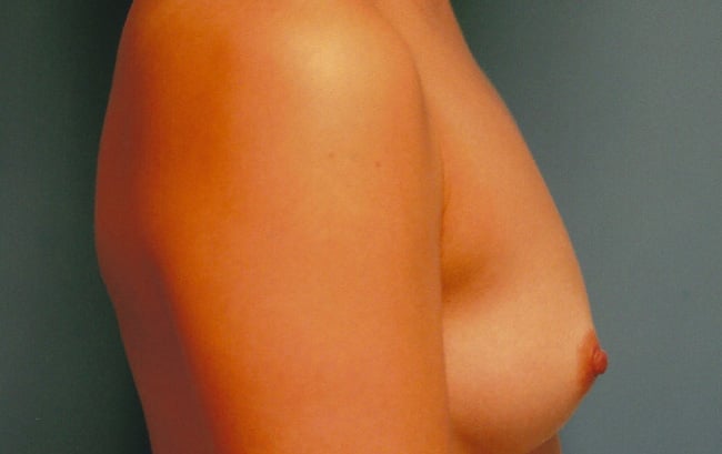 Before — breast augmentation, case 4, Forest Hills Plastic Surgery