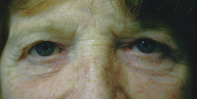 Before — blepharoplasty, case 1, Forest Hills Plastic Surgery