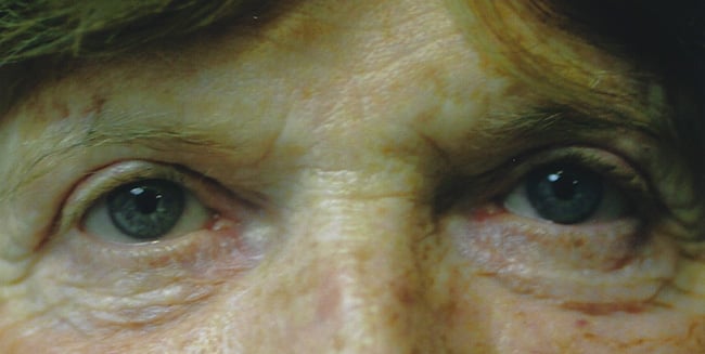 After — blepharoplasty, case 1, Forest Hills Plastic Surgery