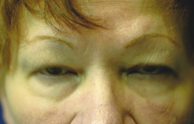 Before — blepharoplasty, case 2, Forest Hills Plastic Surgery