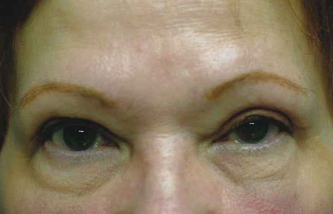 After — blepharoplasty, case 2, Forest Hills Plastic Surgery