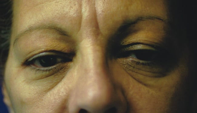 Before — blepharoplasty, case 3, Forest Hills Plastic Surgery