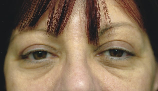 After — blepharoplasty, case 3, Forest Hills Plastic Surgery