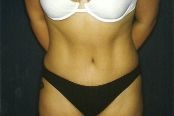 After — abdominoplasty (tummy tuck), case 1, Forest Hills Plastic Surgery
