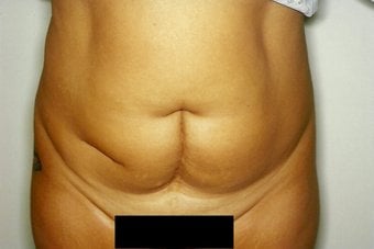 Before — abdominoplasty (tummy tuck), case 1, Forest Hills Plastic Surgery
