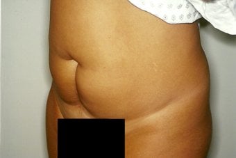 Before — abdominoplasty (tummy tuck), case 2, Forest Hills Plastic Surgery