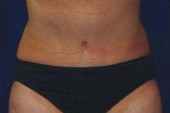 After — abdominoplasty (tummy tuck), case 3, Forest Hills Plastic Surgery