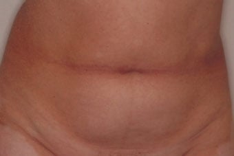 Before — abdominoplasty (tummy tuck), case 3, Forest Hills Plastic Surgery