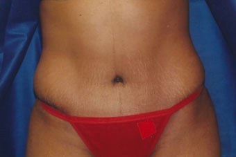 After — abdominoplasty (tummy tuck), case 4, Forest Hills Plastic Surgery