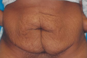 Before — abdominoplasty (tummy tuck), case 4, Forest Hills Plastic Surgery