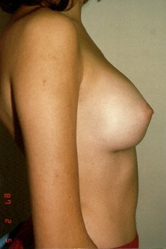 After — breast augmentation, case 6, Forest Hills Plastic Surgery