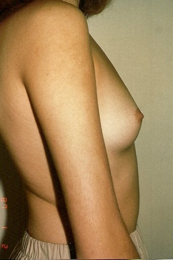 Before — breast augmentation, case 6, Forest Hills Plastic Surgery