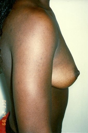 Before — breast augmentation, case 8, Forest Hills Plastic Surgery
