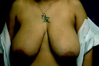 Before — breast reduction, case 1, Forest Hills Plastic Surgery