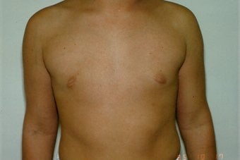 After — male breast reduction, case 1, Forest Hills Plastic Surgery