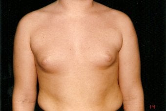Before — male breast reduction, case 1, Forest Hills Plastic Surgery